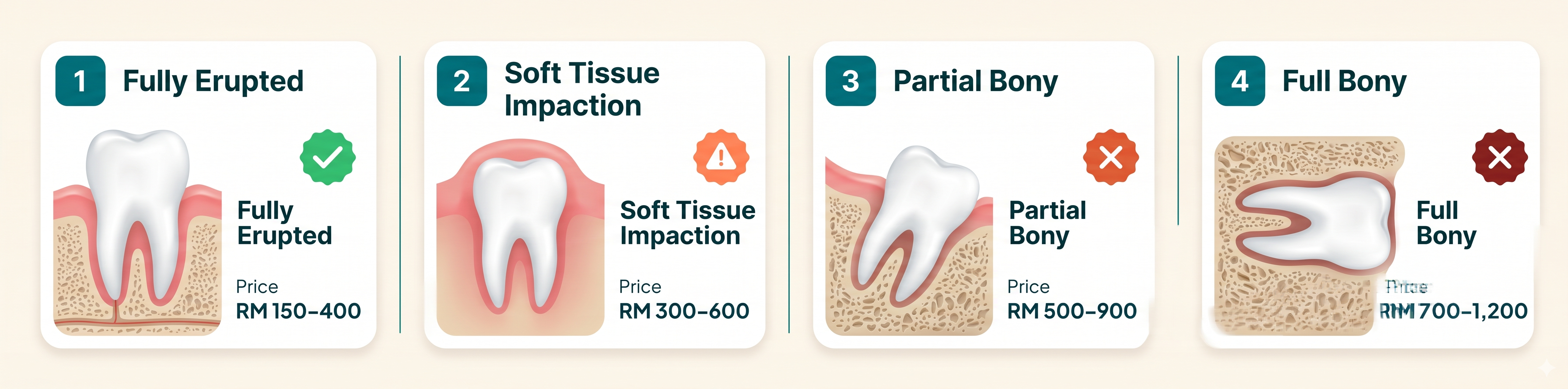 The four types of wisdom tooth impaction — from simple eruption to full bony impaction